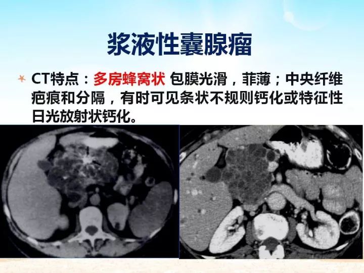 【PPT】胰腺肿瘤的影像诊断