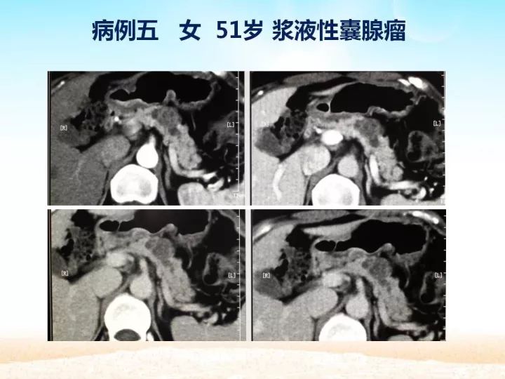 【PPT】胰腺肿瘤的影像诊断