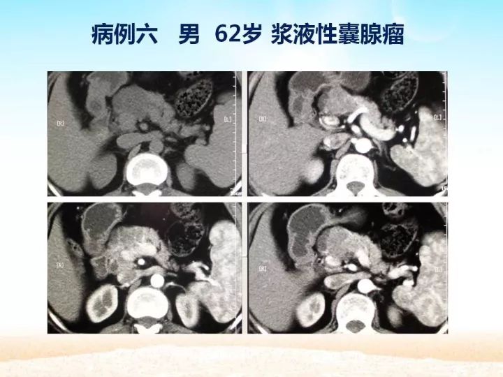 【PPT】胰腺肿瘤的影像诊断