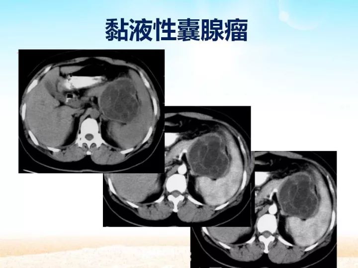 【PPT】胰腺肿瘤的影像诊断