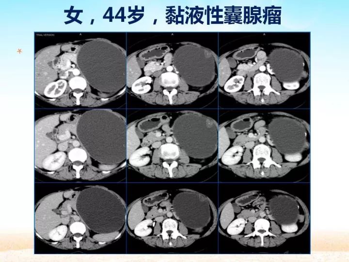 【PPT】胰腺肿瘤的影像诊断