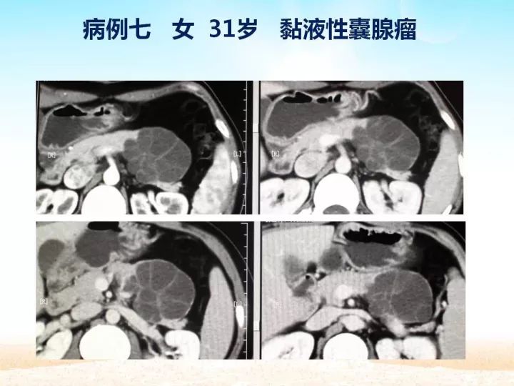 【PPT】胰腺肿瘤的影像诊断