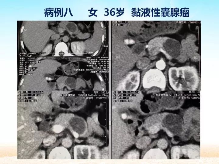 【PPT】胰腺肿瘤的影像诊断