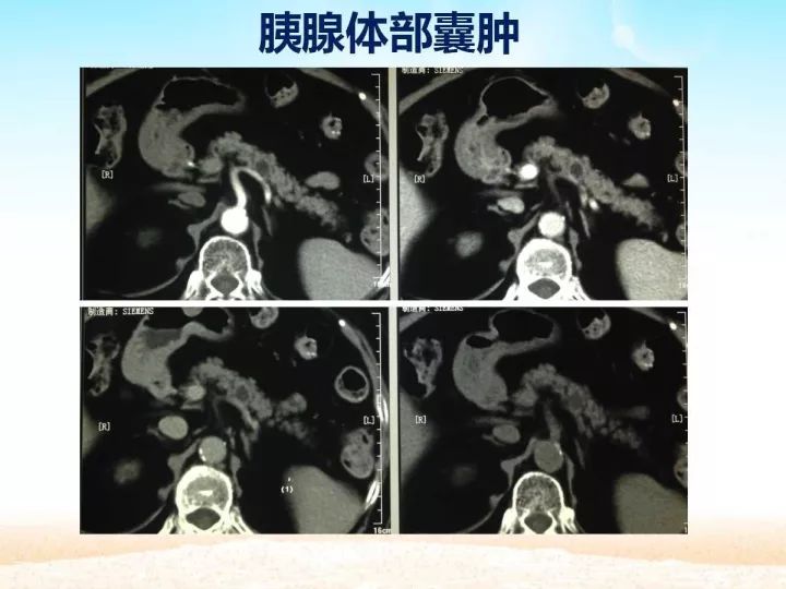 【PPT】胰腺肿瘤的影像诊断