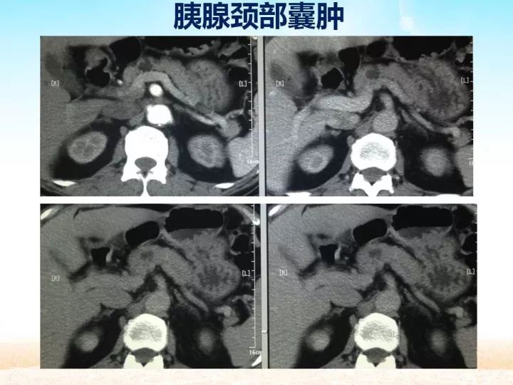 【PPT】胰腺肿瘤的影像诊断
