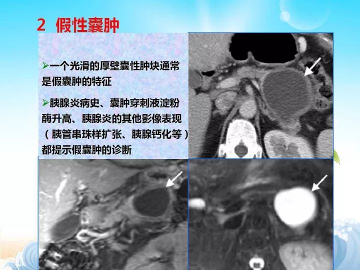 【PPT】胰腺肿瘤的影像诊断