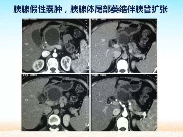 【PPT】胰腺肿瘤的影像诊断
