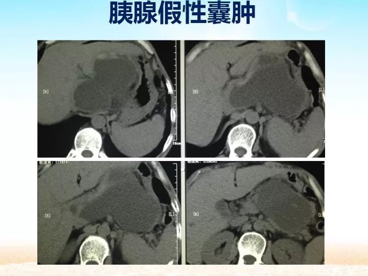 【PPT】胰腺肿瘤的影像诊断