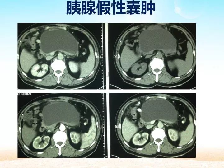 【PPT】胰腺肿瘤的影像诊断