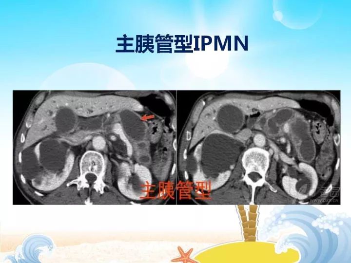 【PPT】胰腺肿瘤的影像诊断