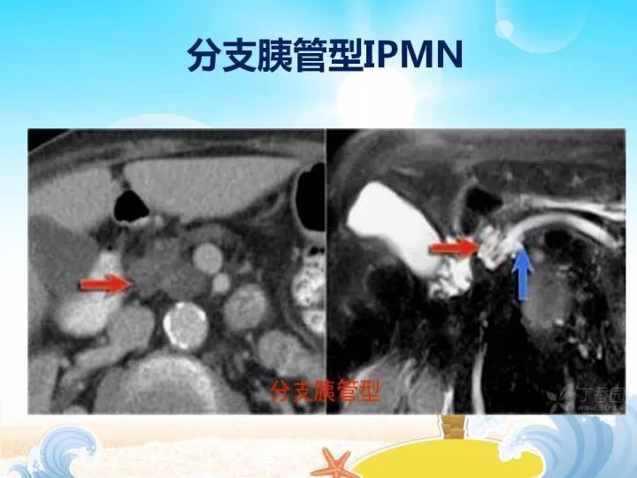 【PPT】胰腺肿瘤的影像诊断