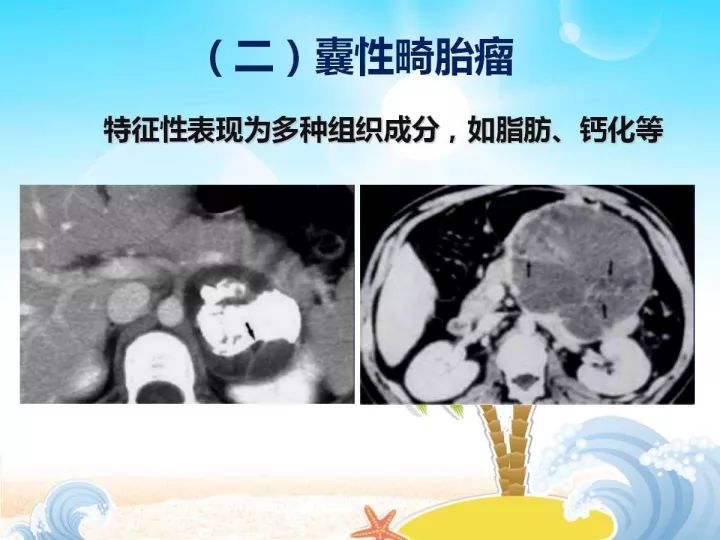 【PPT】胰腺肿瘤的影像诊断