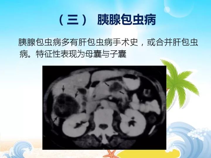 【PPT】胰腺肿瘤的影像诊断