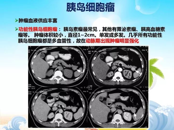 【PPT】胰腺肿瘤的影像诊断