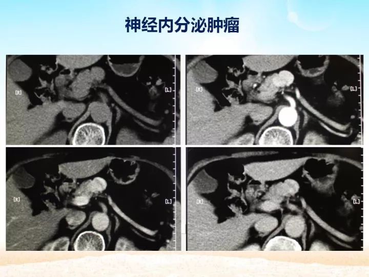 【PPT】胰腺肿瘤的影像诊断