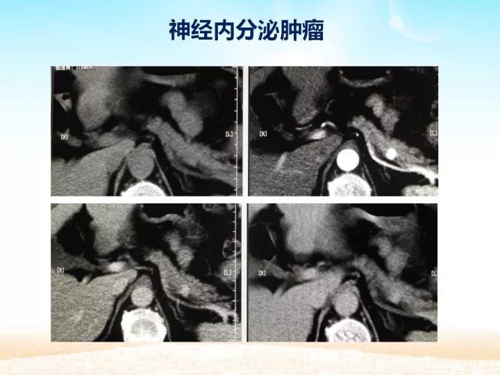 【PPT】胰腺肿瘤的影像诊断