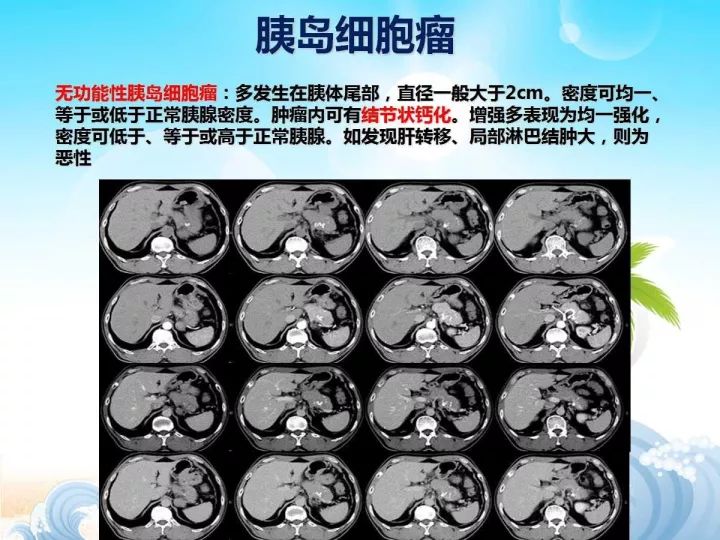 【PPT】胰腺肿瘤的影像诊断