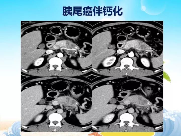 【PPT】胰腺肿瘤的影像诊断
