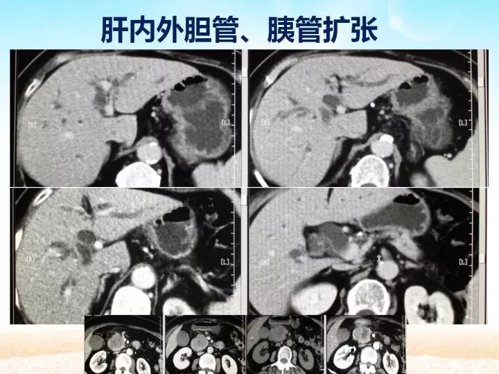 【PPT】胰腺肿瘤的影像诊断