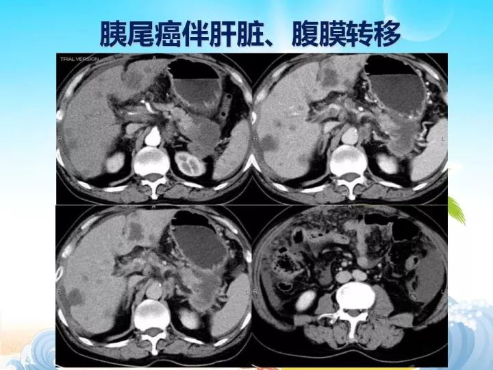 【PPT】胰腺肿瘤的影像诊断