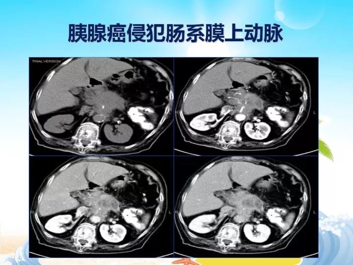 【PPT】胰腺肿瘤的影像诊断