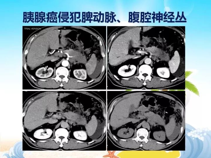 【PPT】胰腺肿瘤的影像诊断
