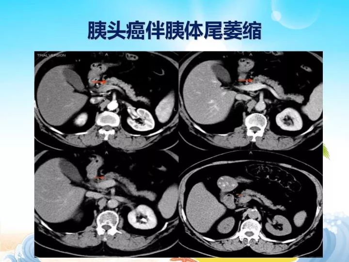 【PPT】胰腺肿瘤的影像诊断