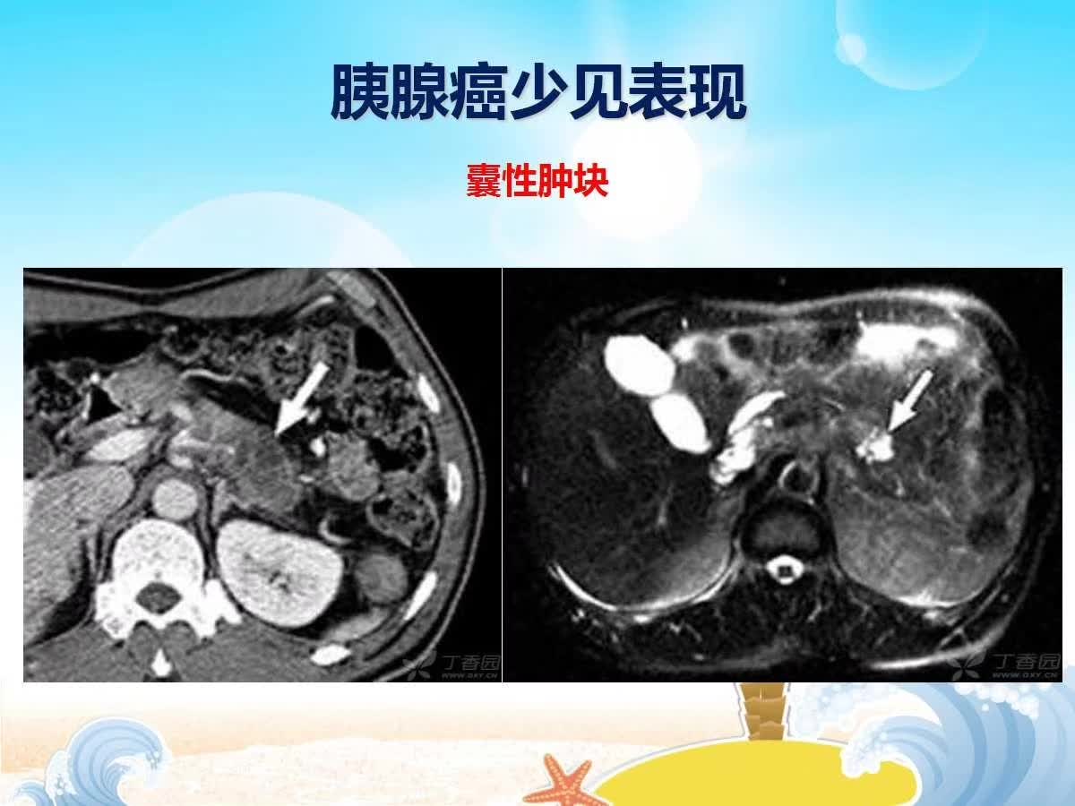 【PPT】胰腺肿瘤的影像诊断