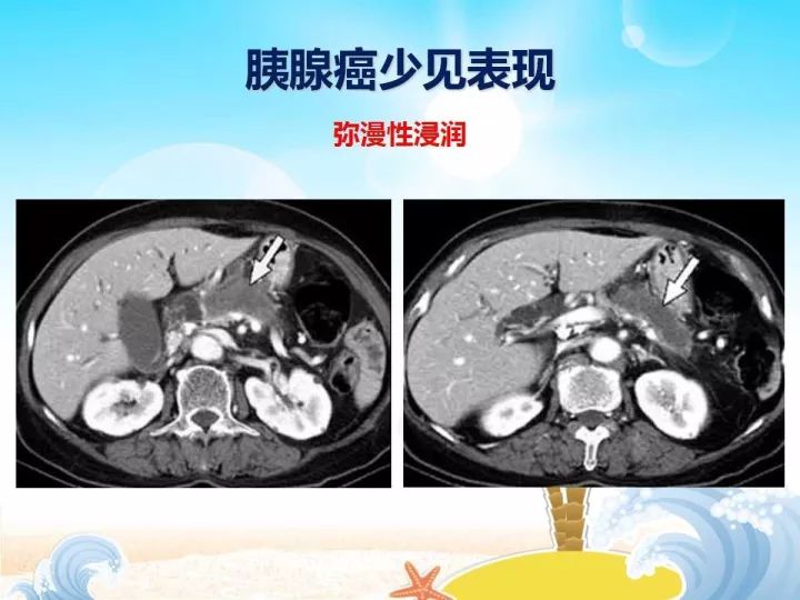 【PPT】胰腺肿瘤的影像诊断