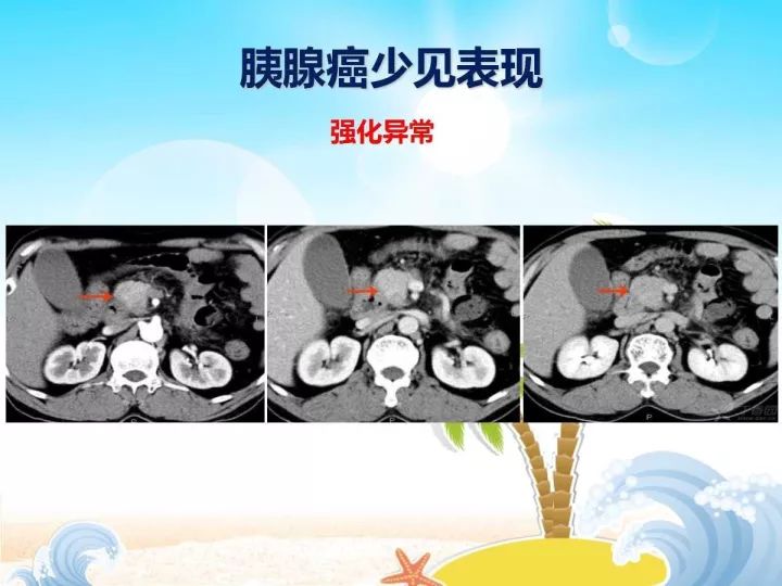 【PPT】胰腺肿瘤的影像诊断