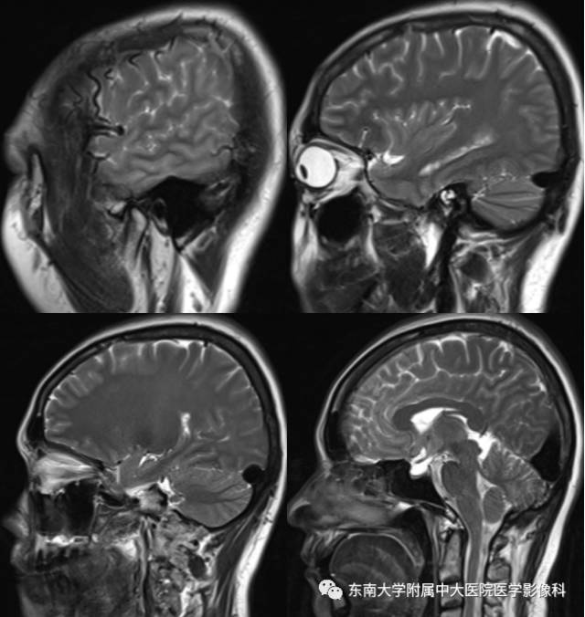 【病例】硬脑膜动静脉瘘1例MR影像诊断