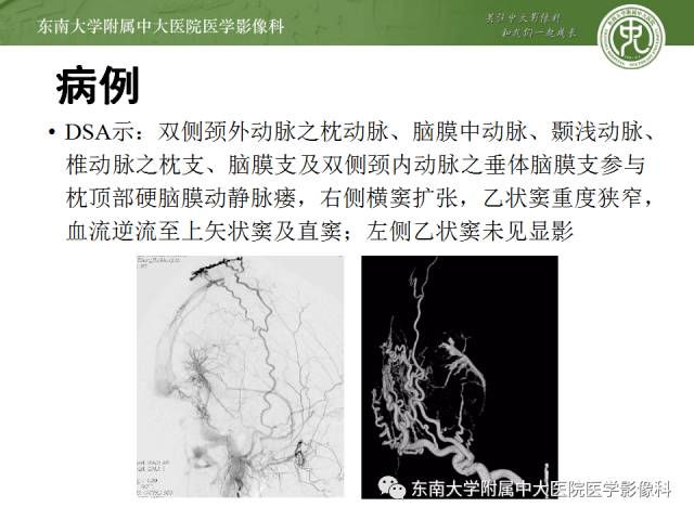 【病例】硬脑膜动静脉瘘1例MR影像诊断