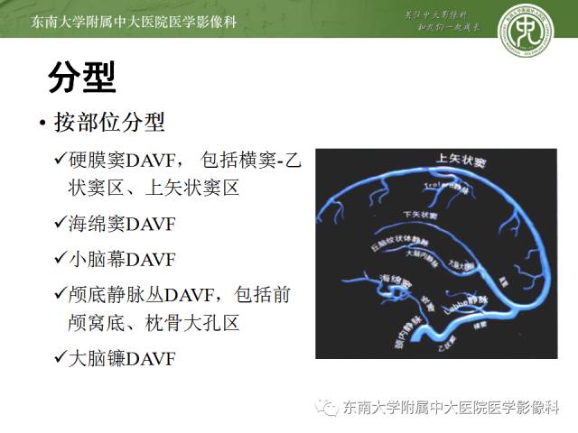 【病例】硬脑膜动静脉瘘1例MR影像诊断