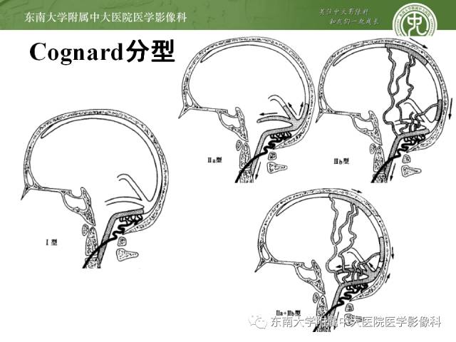 【病例】硬脑膜动静脉瘘1例MR影像诊断