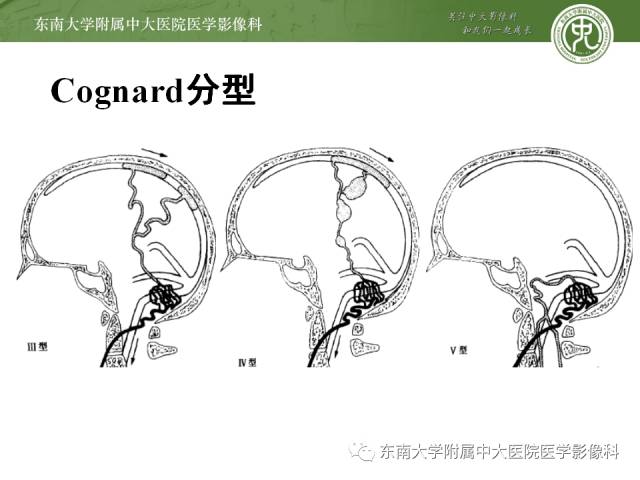 【病例】硬脑膜动静脉瘘1例MR影像诊断