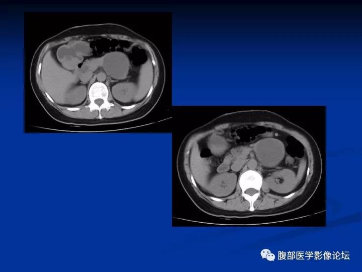 【病例】胰腺尾部囊性占位两例-胰腺囊肿VS副脾表皮样囊肿CT