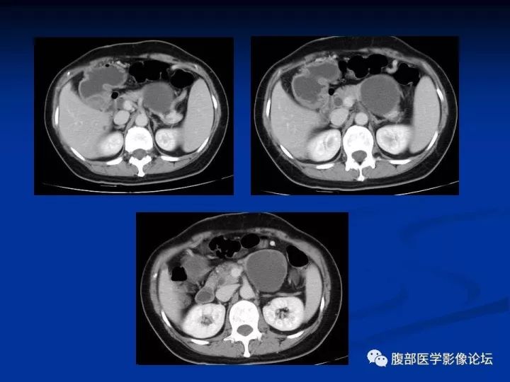 【病例】胰腺尾部囊性占位两例-胰腺囊肿VS副脾表皮样囊肿CT