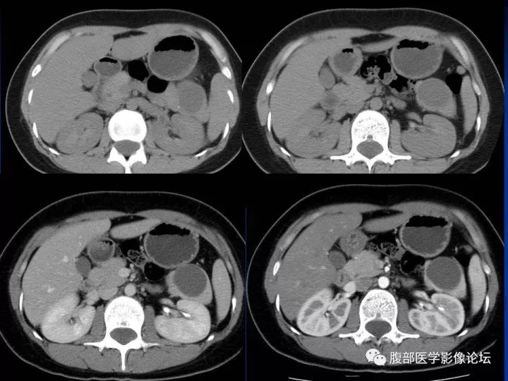 【病例】胰腺尾部囊性占位两例-胰腺囊肿VS副脾表皮样囊肿CT