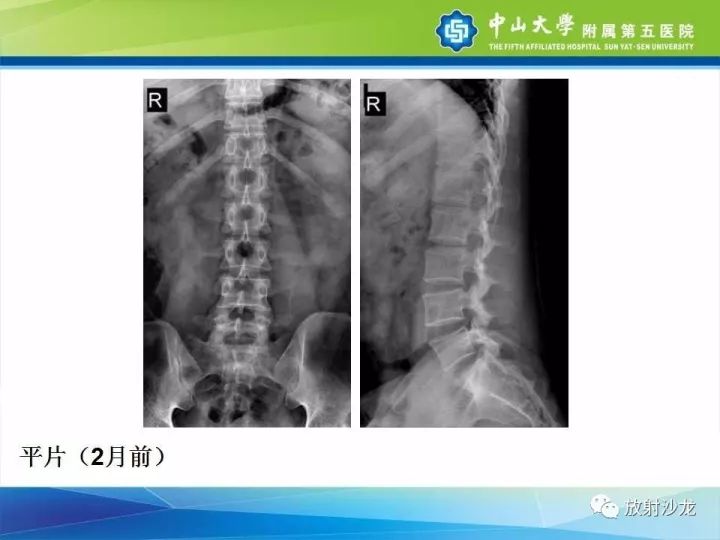 【病例】骶骨结核1例X线CT及MR