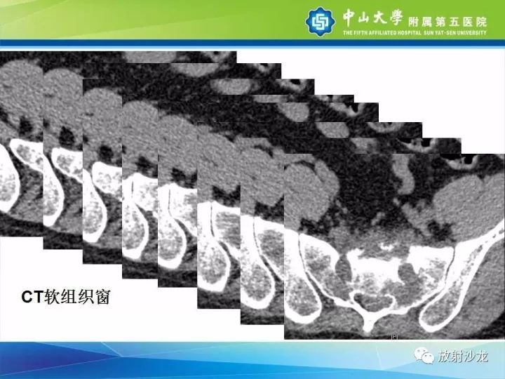【病例】骶骨结核1例X线CT及MR