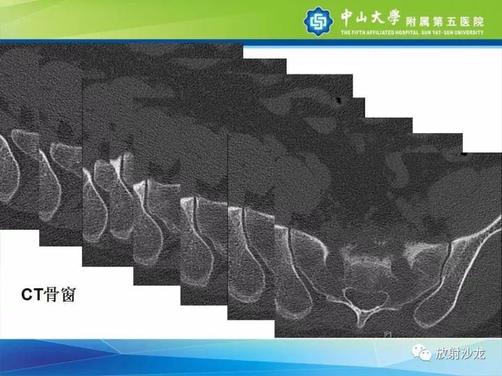 【病例】骶骨结核1例X线CT及MR