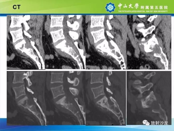 【病例】骶骨结核1例X线CT及MR