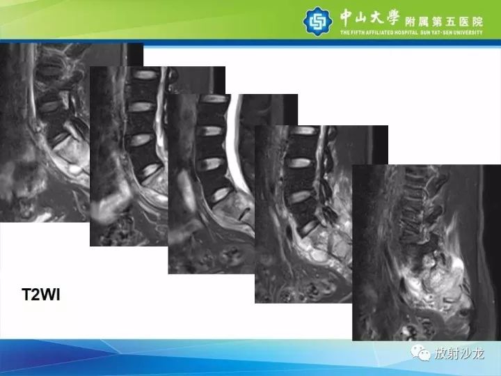 【病例】骶骨结核1例X线CT及MR