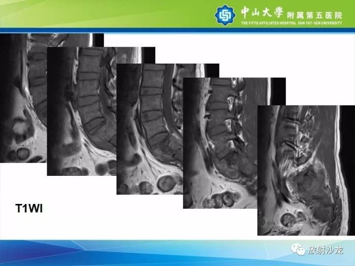 【病例】骶骨结核1例X线CT及MR
