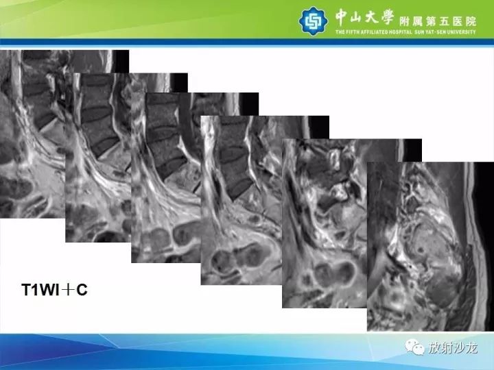 【病例】骶骨结核1例X线CT及MR