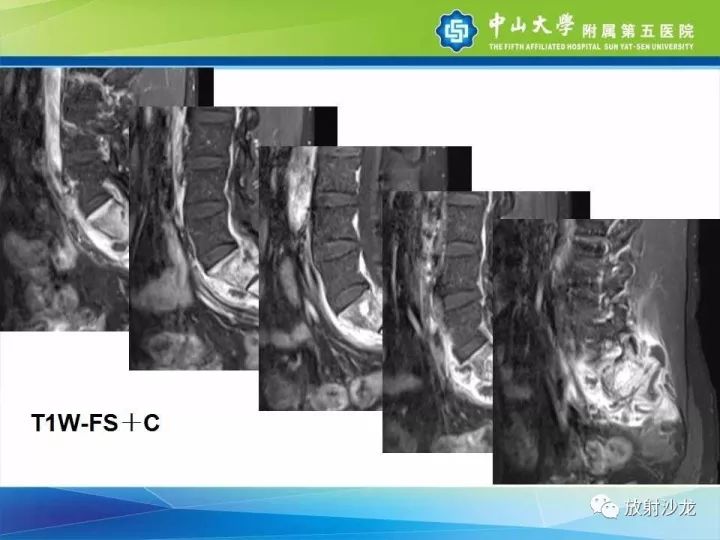 【病例】骶骨结核1例X线CT及MR