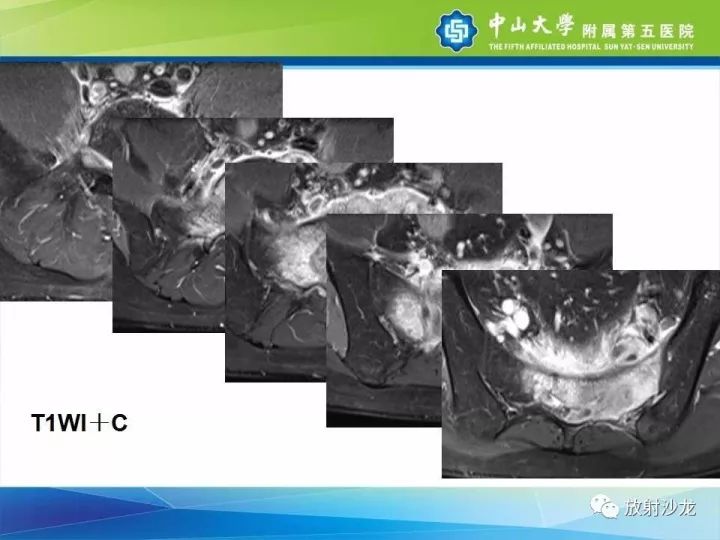 【病例】骶骨结核1例X线CT及MR