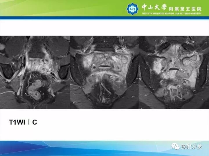 【病例】骶骨结核1例X线CT及MR