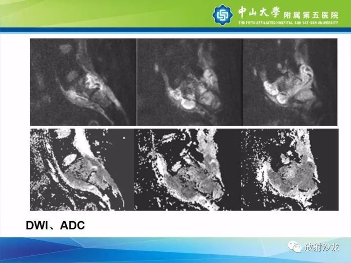 【病例】骶骨结核1例X线CT及MR