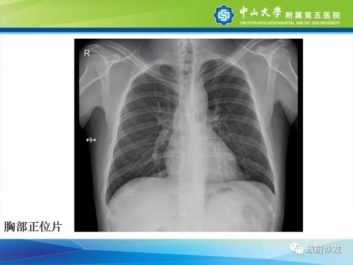 【病例】骶骨结核1例X线CT及MR